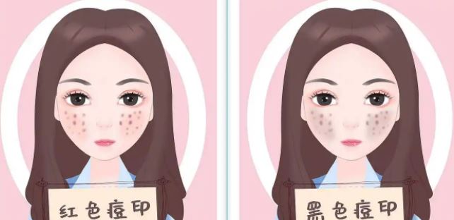 臉上紅色痘印幾個月都不消怎么辦？紅色痘印應(yīng)該怎么消除？