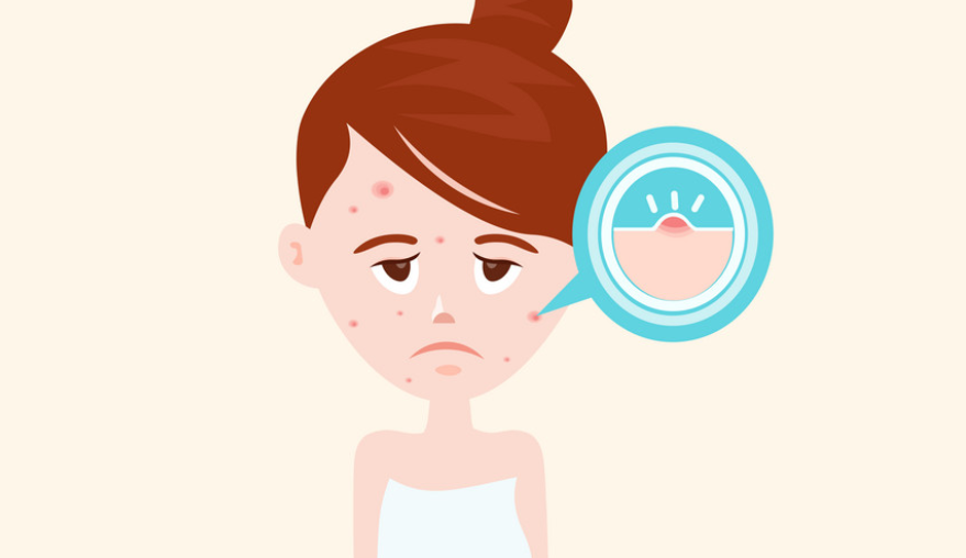 青春痘有救了嗎？聽說青春痘也有疫苗了？